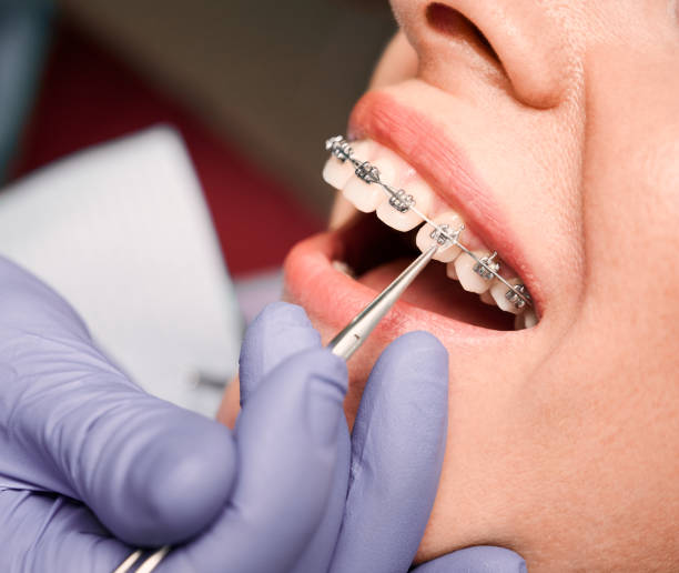 Braces and orthodontic treatment